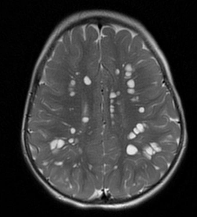 Hipomelanose de Ito caso