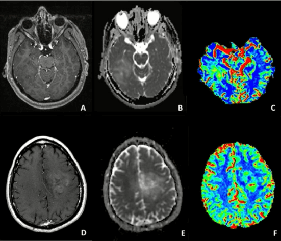 Glioma difuso do adulto: atualizações 2025