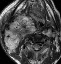Shamblin Paraganglioma