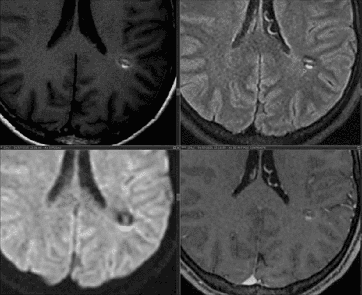 Cavernoma com trato