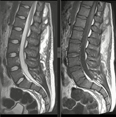 Discussão de caso clinico: RM lombar - trauma