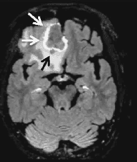Meningioma: o que há de novo nas sequências pós - contraste