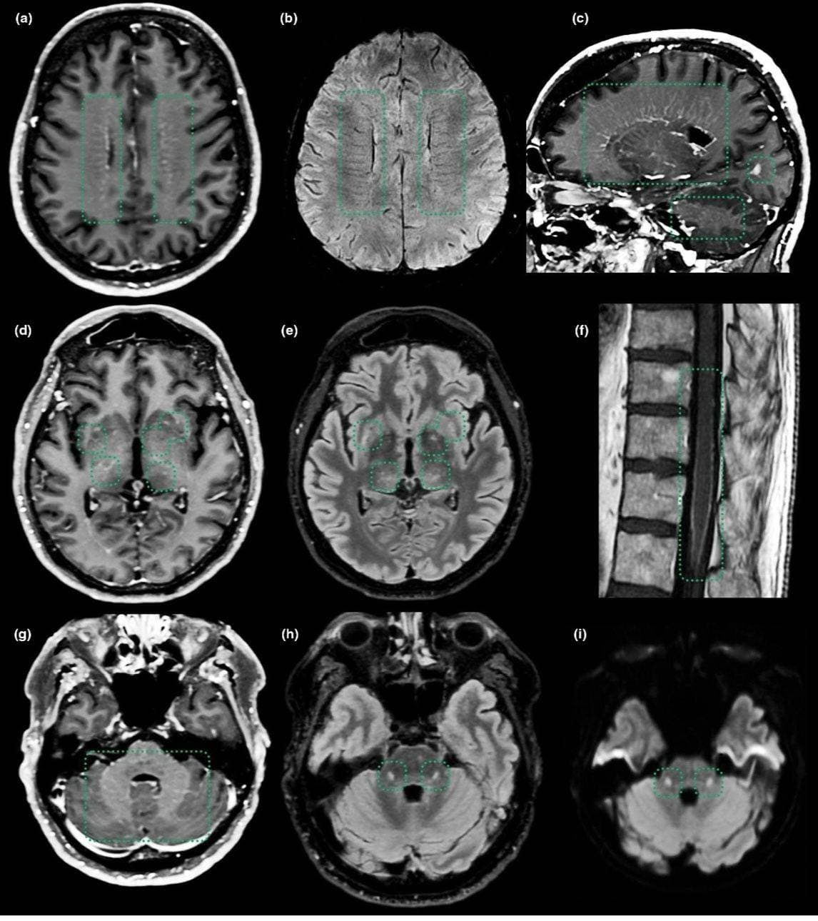 Febre e realce perivascular na RM