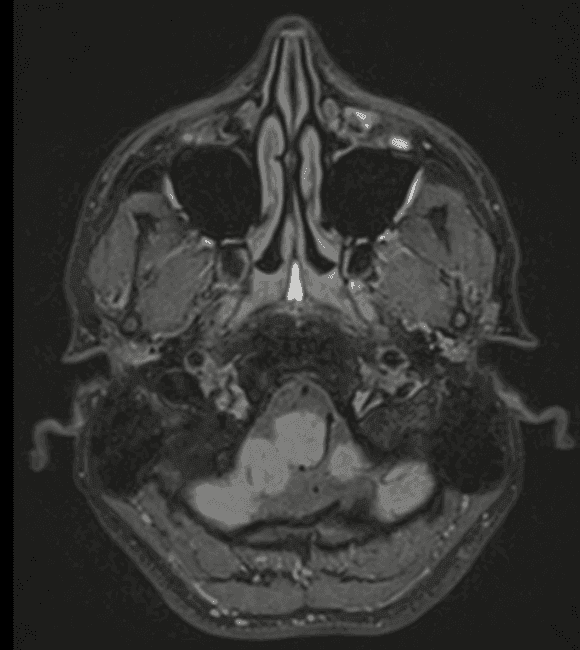 Telangiectasia Capilar: uma apresentação incomum