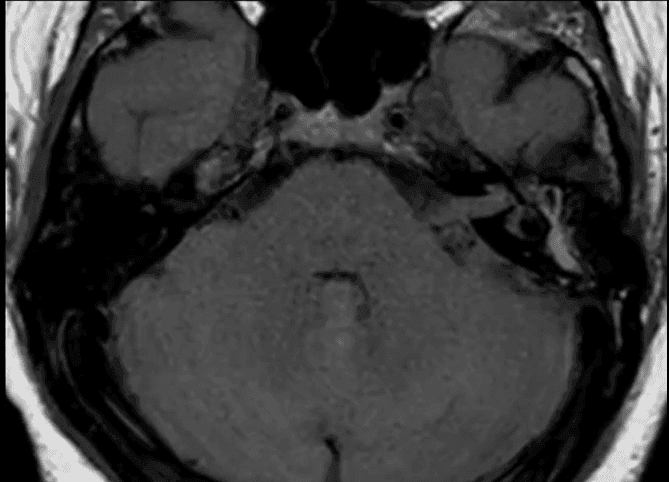 Mastoidite Complicada