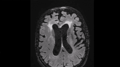 Avastin: avaliação por imagem. Discussão de caso