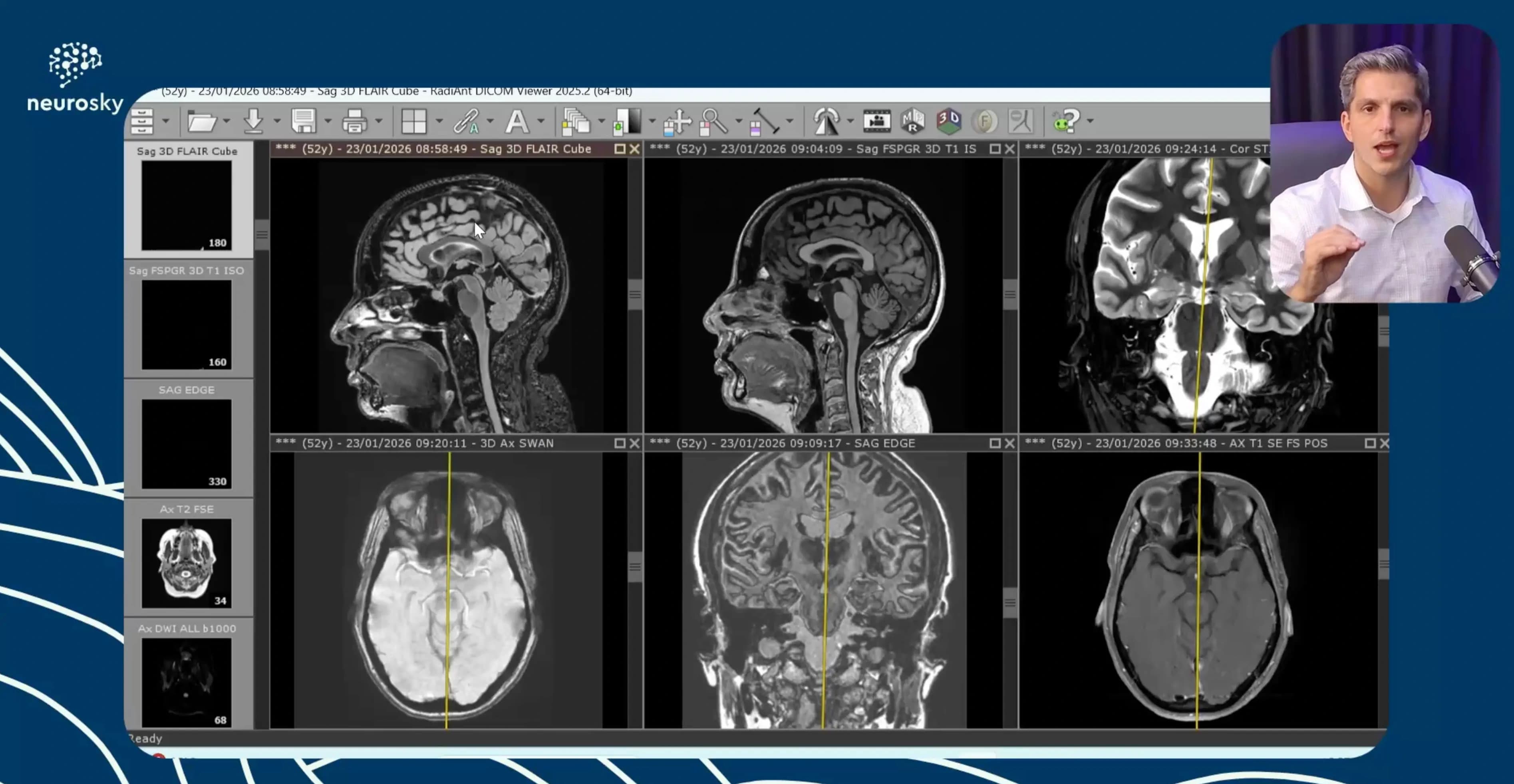 Esclerose Hipocampal Direita com Seq. EDGE
