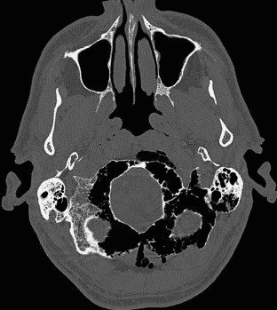 Pneumatização Crânio-Cervical