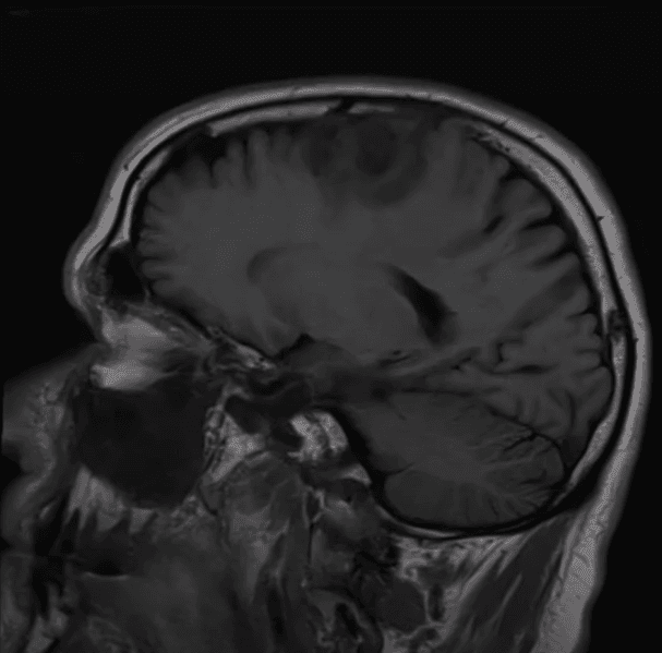 Tumor ou não tumor? - Parte 2