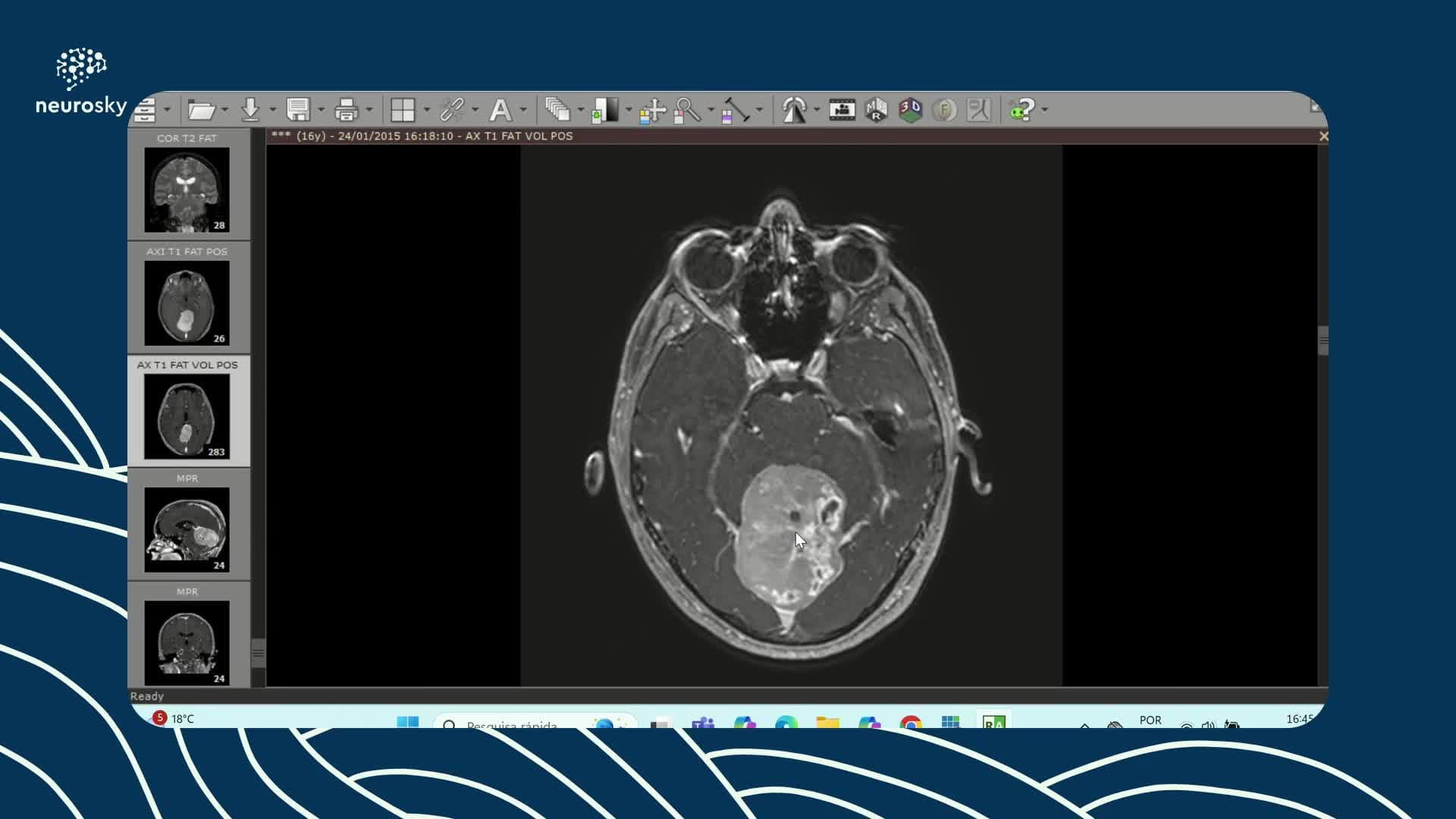 Discussão: Tumor Fibroso Solitário