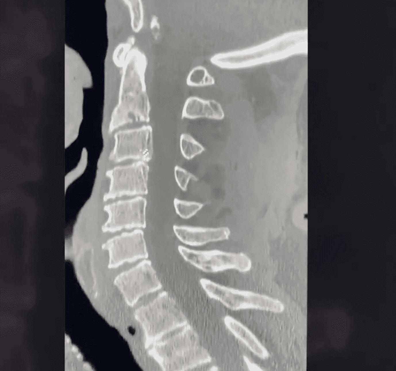 Trauma Cervical: prognóstico detalhado